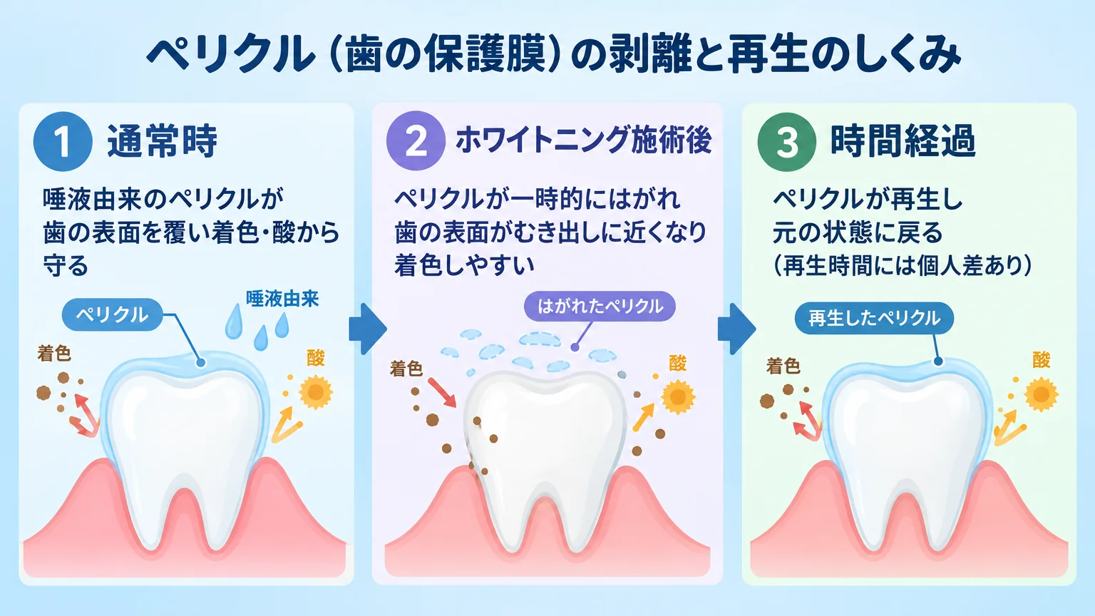 ペリクル(歯の保護膜)の剥離と再生のしくみを示すイラスト。3ステップ:①通常時=唾液由来のペリクルが歯の表面を覆い着色・酸から守る、②ホワイトニング施術後=ペリクルが一時的にはがれ歯の表面がむき出しに近くなり着色しやすい、③時間経過=ペリクルが再生し元の状態に戻る(再生時間には個人差あり)