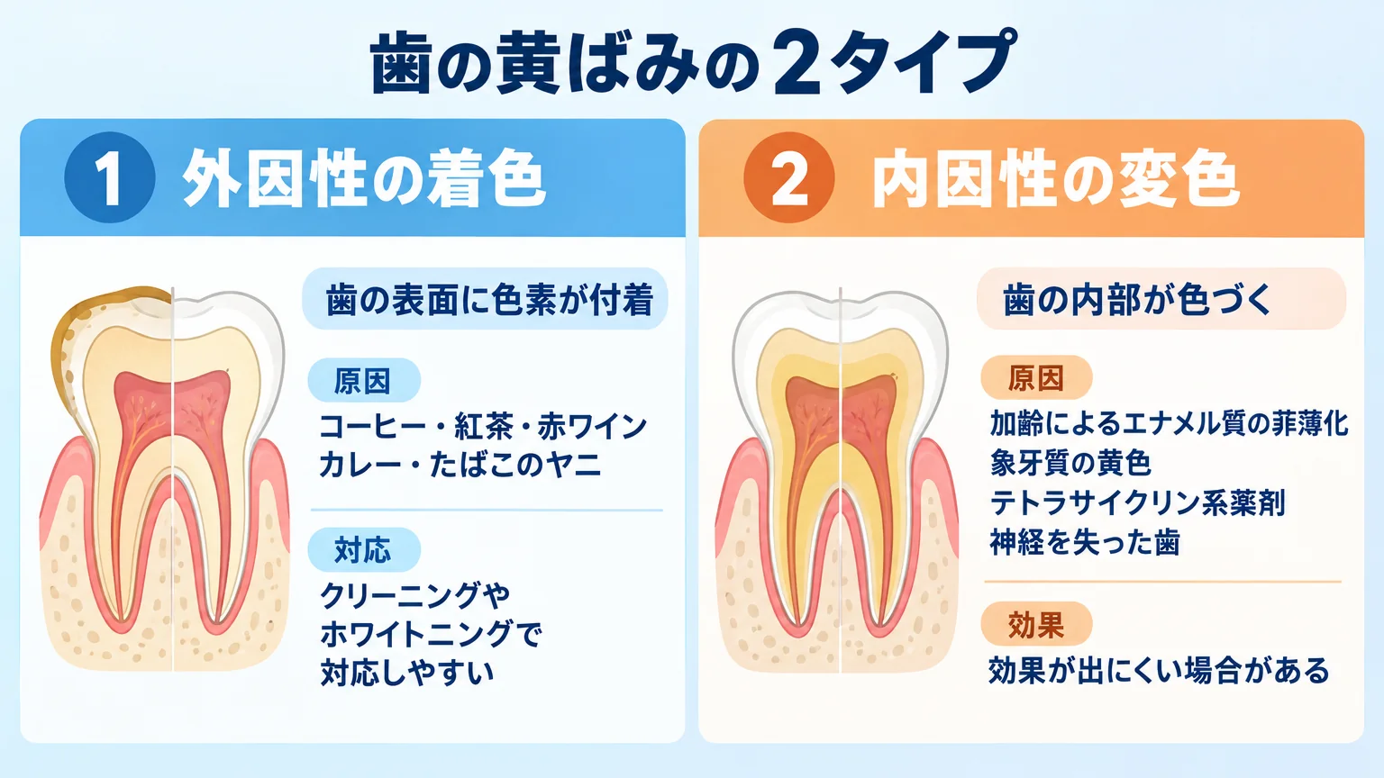 歯の黄ばみの2タイプを対比するイラスト。左に『外因性の着色（歯の表面に色素が付着／原因:コーヒー・紅茶・赤ワイン・カレー・たばこのヤニ／クリーニングやホワイトニングで対応しやすい）』、右に『内因性の変色（歯の内部が色づく／原因:加齢によるエナメル質の菲薄化・象牙質の黄色・テトラサイクリン系薬剤・神経を失った歯／効果が出にくい場合がある）』を並べた断面図イラスト