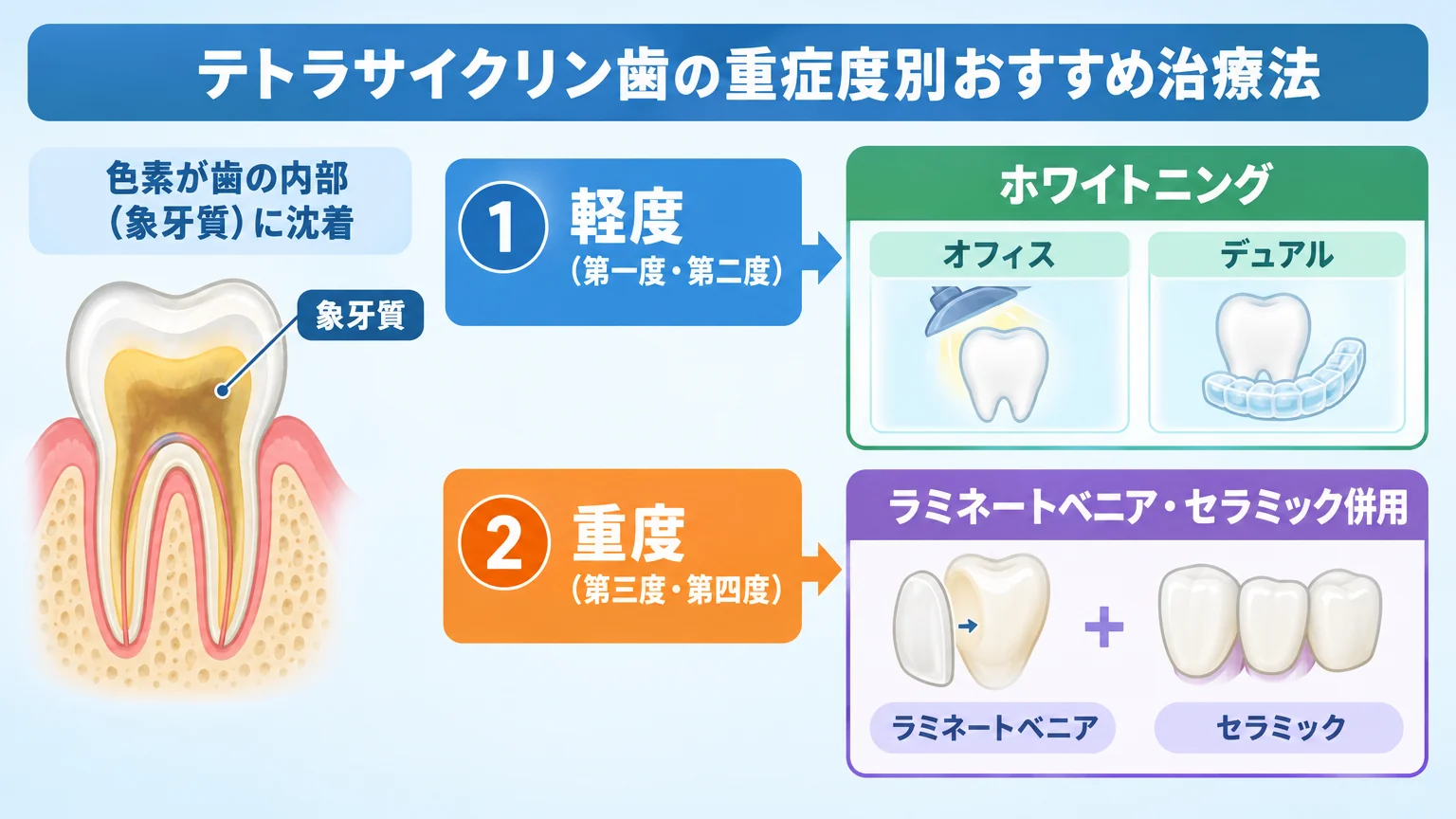 テトラサイクリン歯の重症度別おすすめ治療法フロー図。軽度(第一度・第二度)→ホワイトニング(オフィス/デュアル)、重度(第三度・第四度)→ラミネートベニア・セラミック併用。色素が歯の内部(象牙質)に沈着している断面イラストを添える