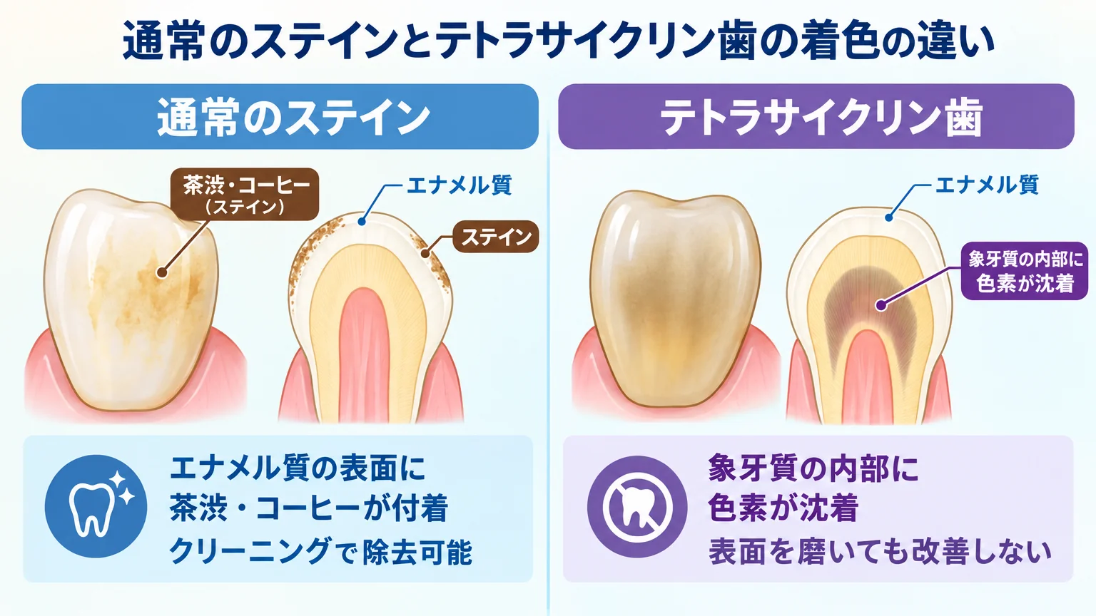 通常のステイン着色とテトラサイクリン歯の着色の違いを示す比較イラスト。左:通常のステイン=エナメル質の表面に茶渋・コーヒーが付着(クリーニングで除去可能)、右:テトラサイクリン歯=象牙質の内部に色素が沈着(表面を磨いても改善しない)