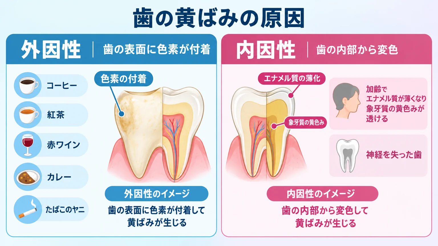 歯の黄ばみの原因を外因性と内因性に分けて説明するイラスト。左側『外因性＝歯の表面に色素が付着（コーヒー・紅茶・赤ワイン・カレー・たばこのヤニ）』、右側『内因性＝歯の内部から変色（加齢でエナメル質が薄くなり象牙質の黄色みが透ける・神経を失った歯）』を歯の断面図とともに対比したイラスト