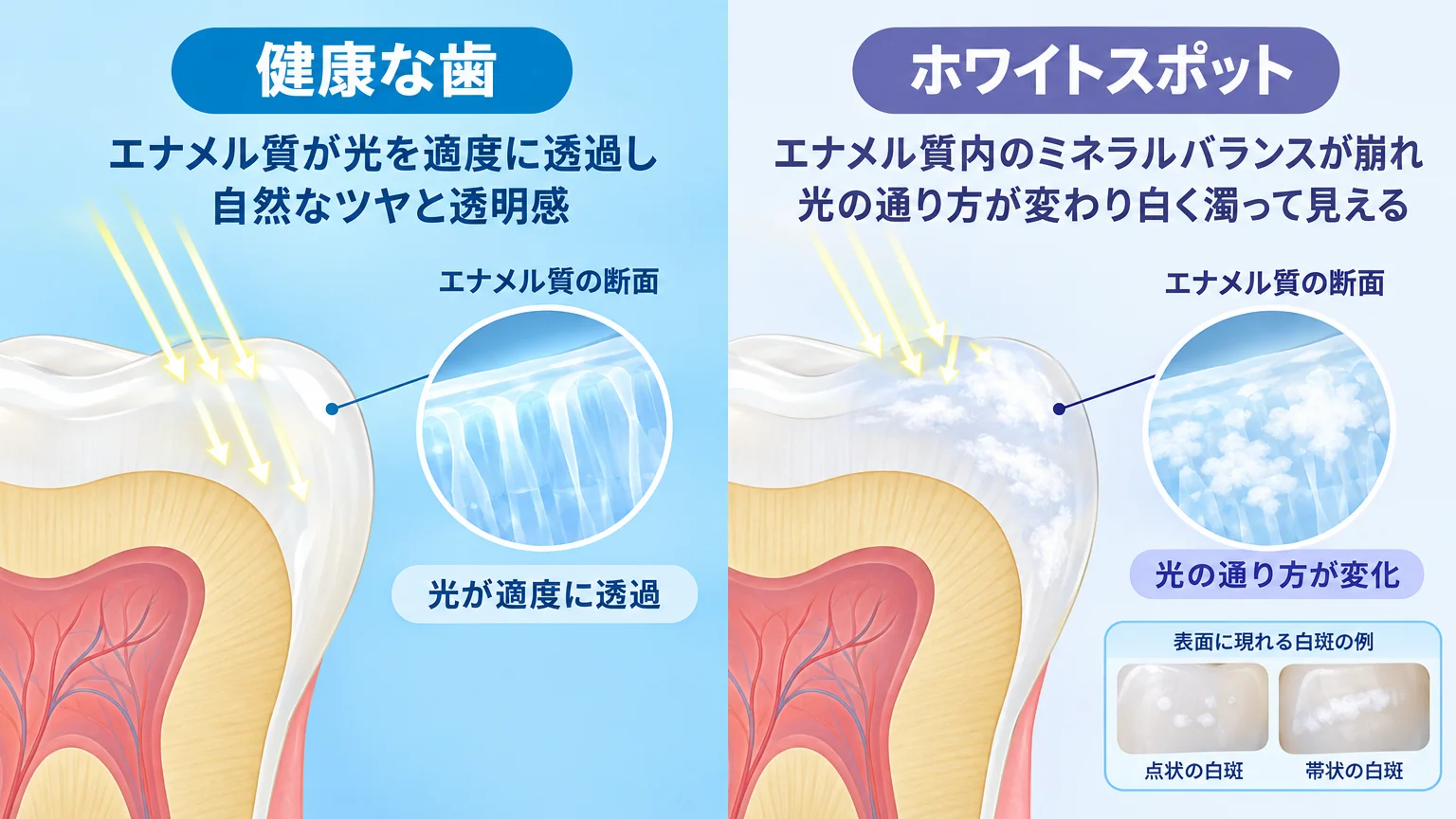 健康なエナメル質とホワイトスポットの断面を左右で比較したイラスト。左『健康な歯：エナメル質が光を適度に透過し自然なツヤと透明感』、右『ホワイトスポット：エナメル質内のミネラルバランスが崩れ光の通り方が変わり白く濁って見える』。表面に点状・帯状の白斑が出る様子を図示