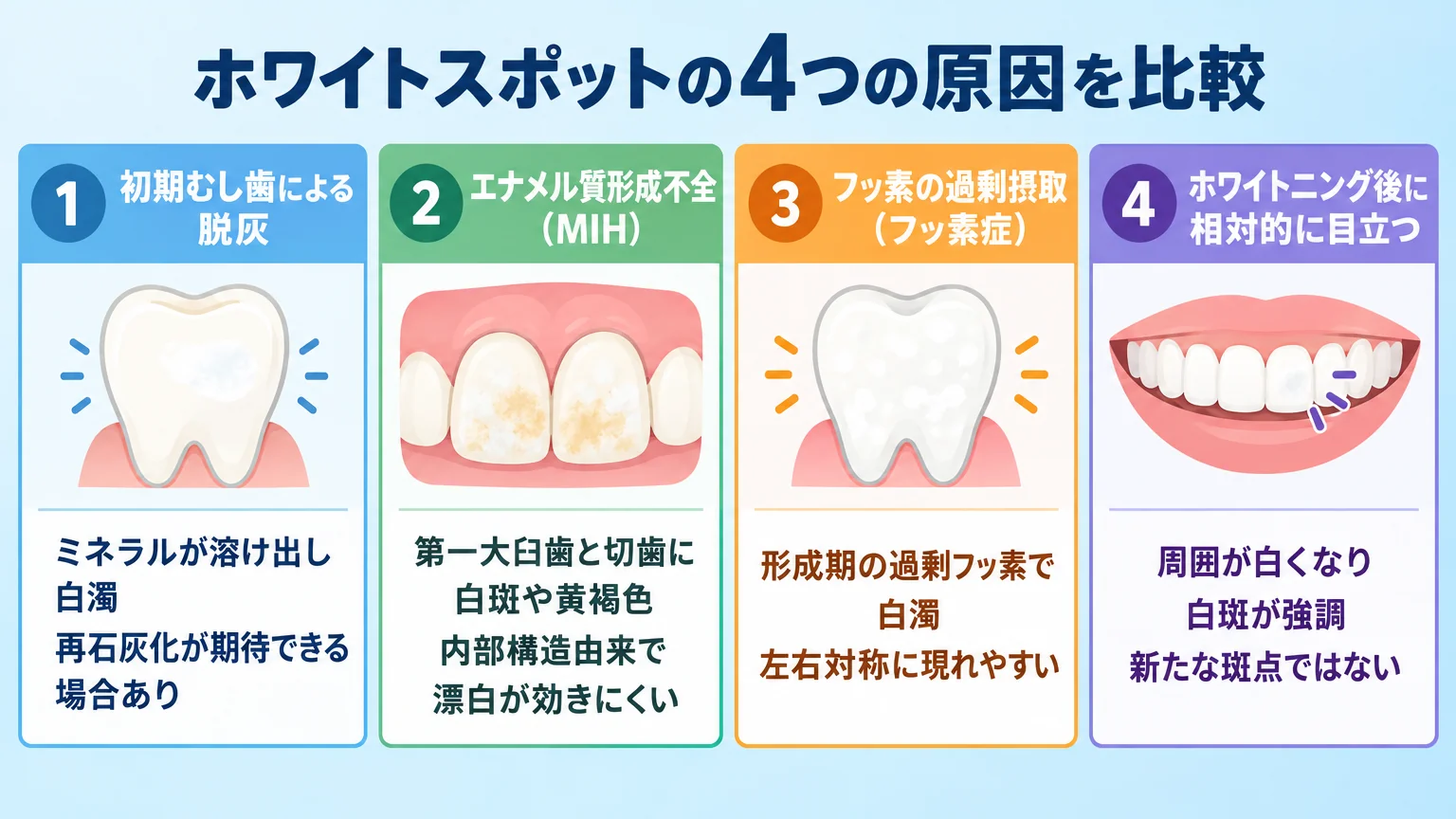 ホワイトスポットの4つの原因を比較するインフォグラフィック。4列『初期むし歯による脱灰：ミネラルが溶け出し白濁、再石灰化が期待できる場合あり』『エナメル質形成不全(MIH)：第一大臼歯と切歯に白斑や黄褐色、内部構造由来で漂白が効きにくい』『フッ素の過剰摂取(フッ素症)：形成期の過剰フッ素で白濁、左右対称に現れやすい』『ホワイトニング後に相対的に目立つ：周囲が白くなり白斑が強調、新たな斑点ではない』