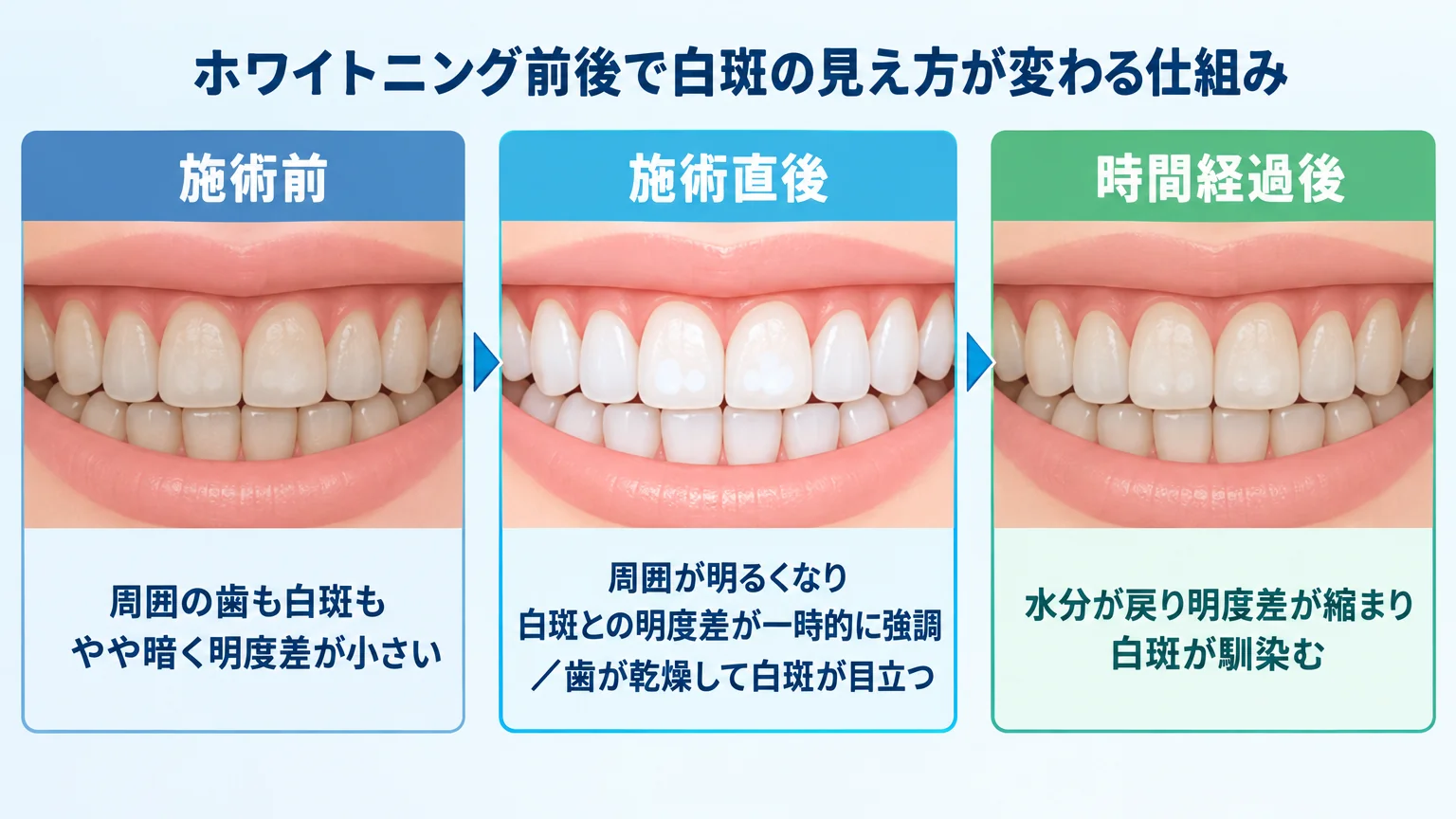ホワイトニング前後で白斑の見え方が変わる仕組みのイラスト。左『施術前：周囲の歯も白斑もやや暗く明度差が小さい』、中央『施術直後：周囲が明るくなり白斑との明度差が一時的に強調／歯が乾燥して白斑が目立つ』、右『時間経過後：水分が戻り明度差が縮まり白斑が馴染む』の3コマ構成