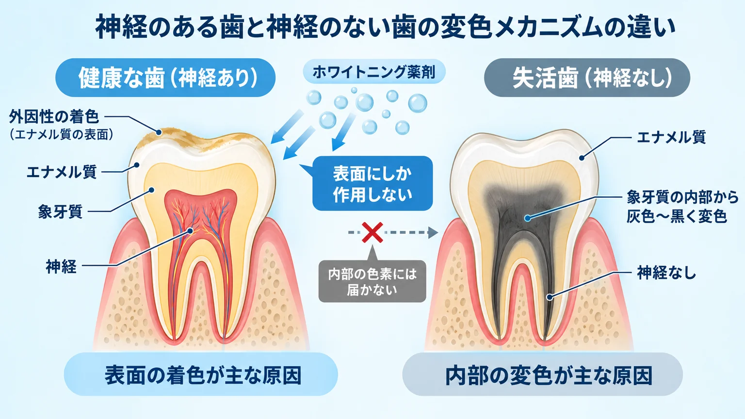 神経のある歯と神経のない歯の変色メカニズムの違いを示す断面イラスト。左側=健康な歯（神経あり）はエナメル質表面に外因性の着色、右側=失活歯（神経なし）は象牙質の内部から灰色〜黒く変色。矢印でホワイトニング薬剤が表面にしか作用せず内部色素に届かない様子を図示