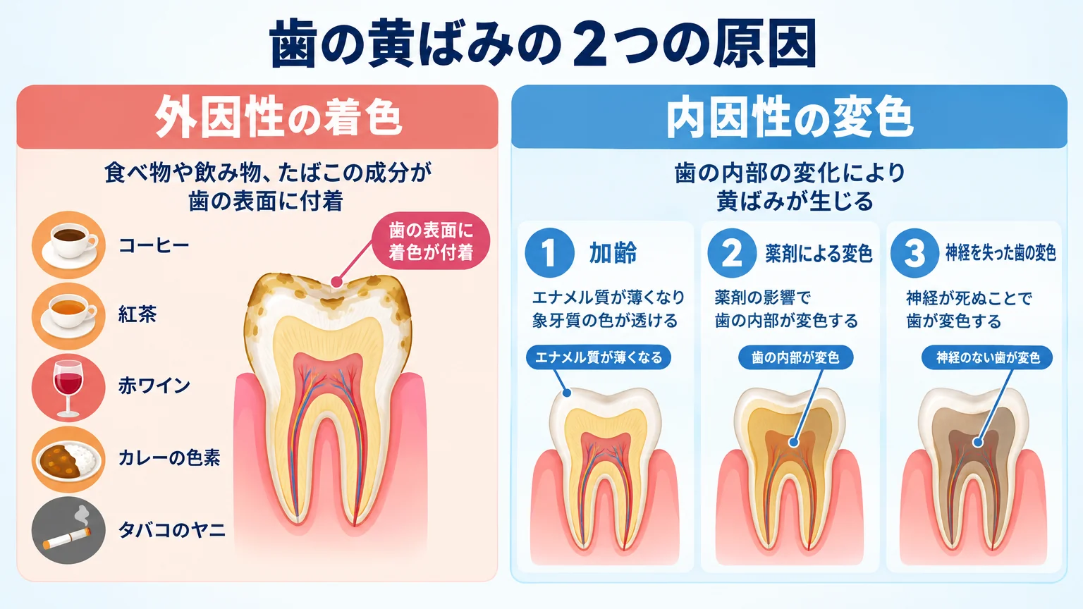 歯の黄ばみの2つの原因を対比するイラスト図。左側に外因性の着色（コーヒー・紅茶・赤ワイン・カレーの色素、タバコのヤニが歯の表面に付着）、右側に内因性の変色（加齢でエナメル質が薄くなり象牙質の色が透ける、薬剤による変色、神経を失った歯の変色）を歯の断面図で表現