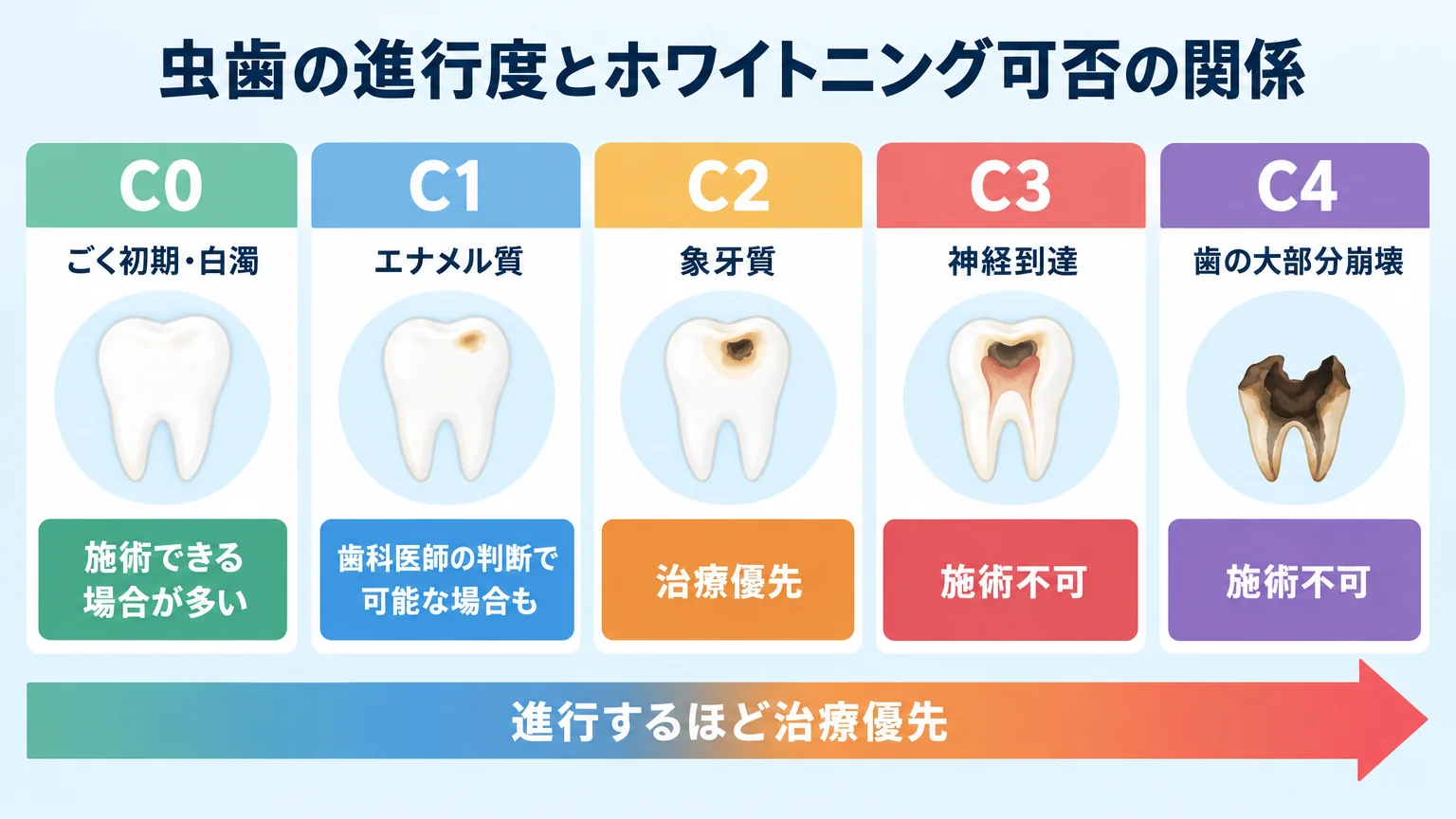 虫歯の進行度C0〜C4とホワイトニング可否の関係を示すインフォグラフィック。C0（ごく初期・白濁）=施術できる場合が多い、C1（エナメル質）=歯科医師の判断で可能な場合も、C2（象牙質）=治療優先、C3（神経到達）=施術不可、C4（歯の大部分崩壊）=施術不可。進行するほど治療優先になることを矢印で表現