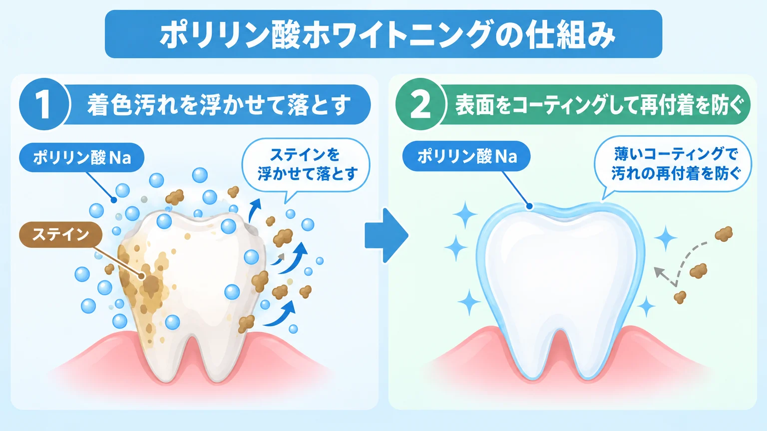 ポリリン酸ホワイトニングの仕組みを示すイラスト。歯の表面の着色汚れ(ステイン)をポリリン酸Naが浮かせて落とす様子と、その後に歯の表面を薄くコーティングして汚れの再付着を防ぐ様子を2ステップで図解。ステップ1『着色汚れを浮かせて落とす』、ステップ2『表面をコーティングして再付着を防ぐ』のラベル付き