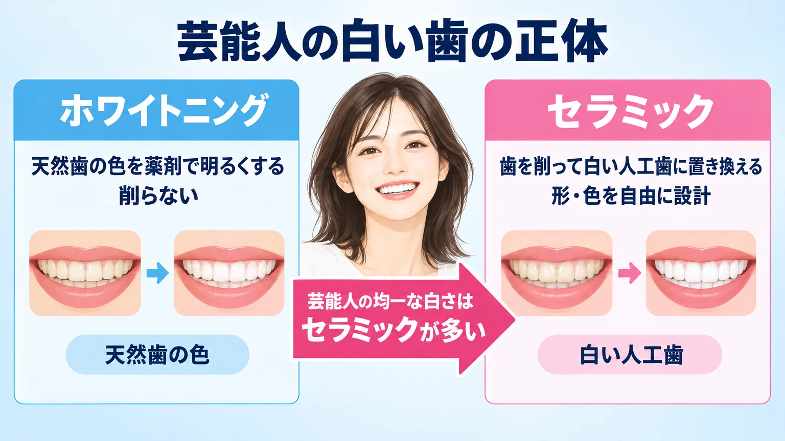芸能人の白い歯の正体を示す比較イラスト。左側に『ホワイトニング(天然歯の色を薬剤で明るくする/削らない)』、右側に『セラミック(歯を削って白い人工歯に置き換える/形・色を自由に設計)』の2つを並べ、芸能人の均一な白さは右のセラミックが多いことを矢印で示す