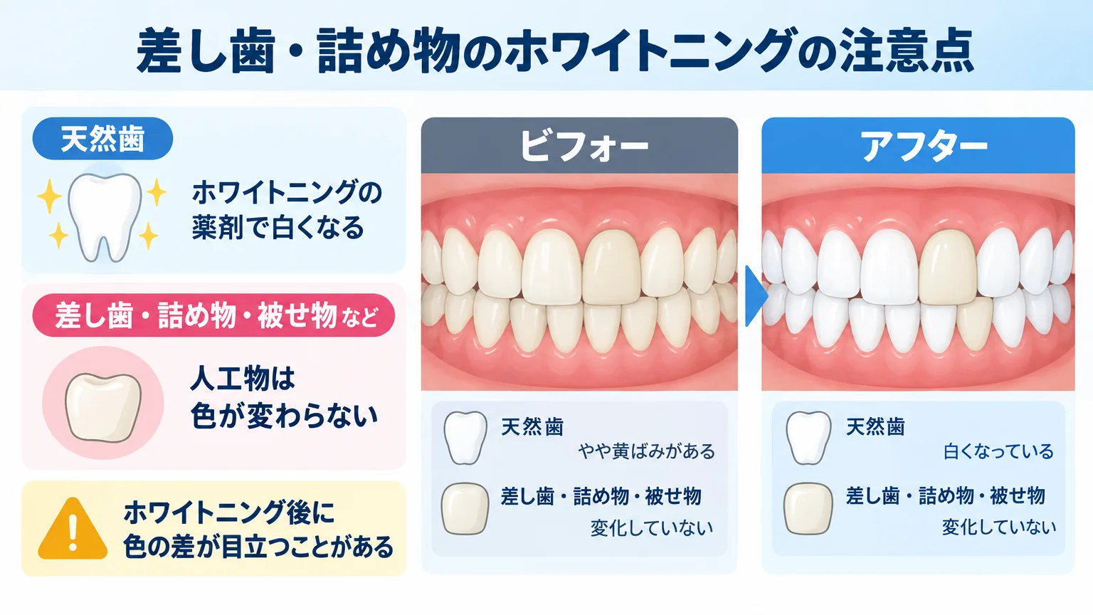差し歯・詰め物がある歯のホワイトニングの注意点を示すイラスト。天然歯は薬剤で白くなるが、差し歯・詰め物・被せ物などの人工物は色が変わらず、ホワイトニング後に色の差が目立つ様子を、ビフォー・アフターの歯列図で示す