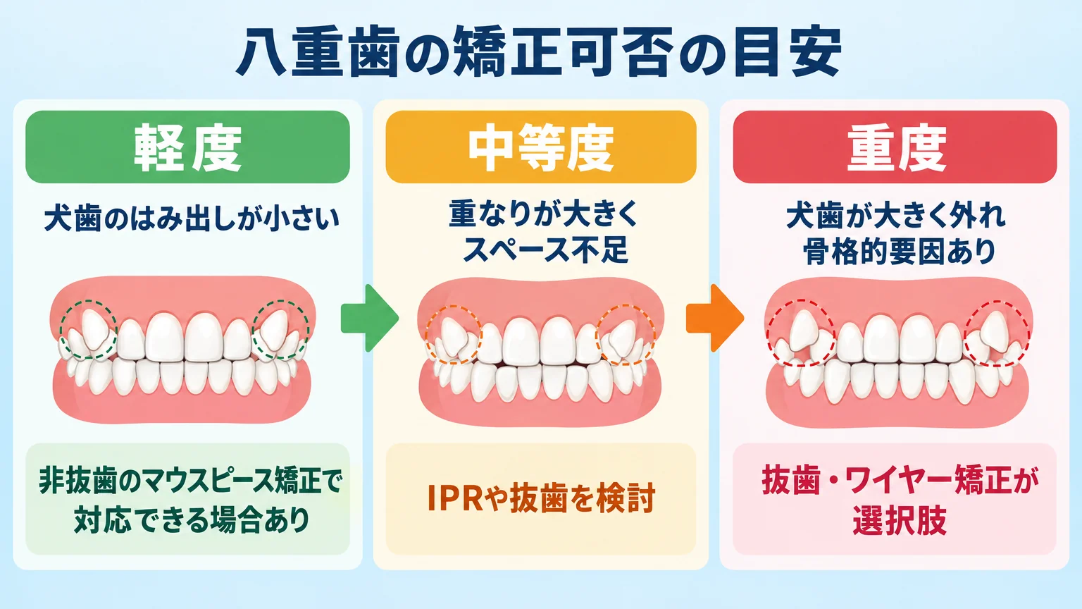 八重歯の矯正可否を示す3段階の境界線インフォグラフィック。左から「軽度:犬歯のはみ出しが小さい→非抜歯のマウスピース矯正で対応できる場合あり」「中等度:重なりが大きくスペース不足→IPRや抜歯を検討」「重度:犬歯が大きく外れ骨格的要因あり→抜歯・ワイヤー矯正が選択肢」の3ブロックを矢印でつなぐ。各ブロックに歯列と犬歯の位置を示す簡易イラストを添える