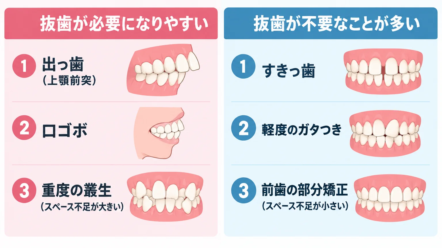 抜歯が必要になりやすい症例と不要なことが多い症例の対比インフォグラフィック。左側『抜歯が必要になりやすい』=出っ歯(上顎前突)・口ゴボ・重度の叢生(スペース不足が大きい)。右側『抜歯が不要なことが多い』=すきっ歯・軽度のガタつき・前歯の部分矯正(スペース不足が小さい)。歯並びのイラストを添える