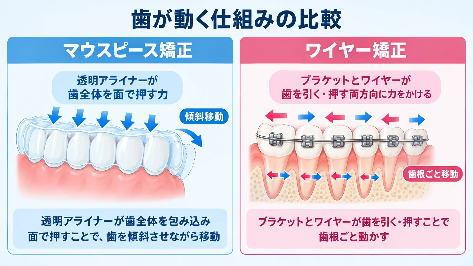 マウスピース矯正とワイヤー矯正の歯が動く仕組みの比較イラスト。左:マウスピース矯正は透明アライナーが歯全体を『面で押す力』で傾斜移動させる様子を矢印で表示。右:ワイヤー矯正はブラケットとワイヤーが歯を『引く・押す』両方向に力をかけ歯根ごと動かす様子を矢印で表示