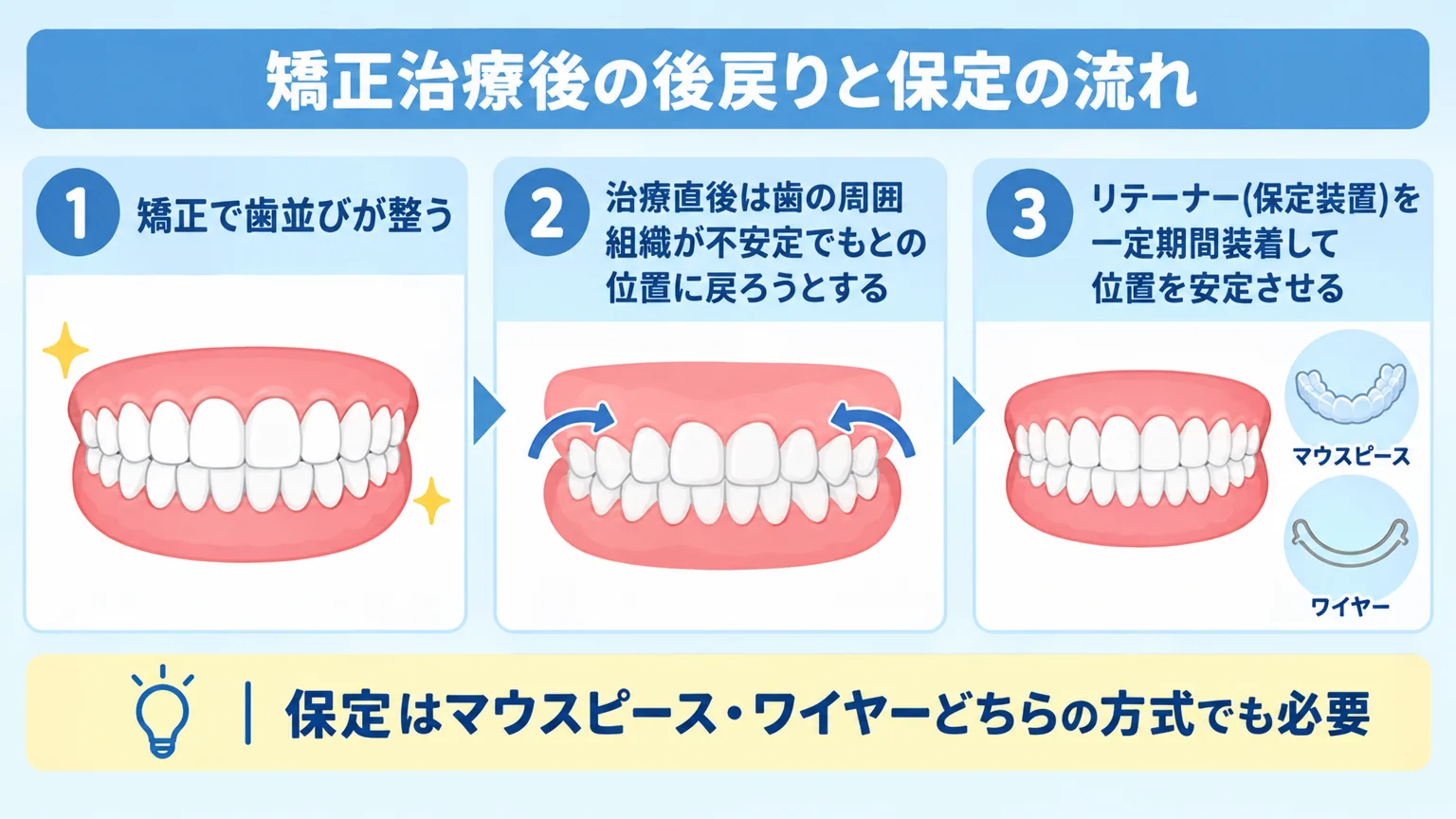 矯正治療後の後戻りと保定の流れを示すイラスト。ステップ1:矯正で歯並びが整う→ステップ2:治療直後は歯の周囲組織が不安定でもとの位置に戻ろうとする→ステップ3:リテーナー(保定装置)を一定期間装着して位置を安定させる。注記『保定はマウスピース・ワイヤーどちらの方式でも必要』