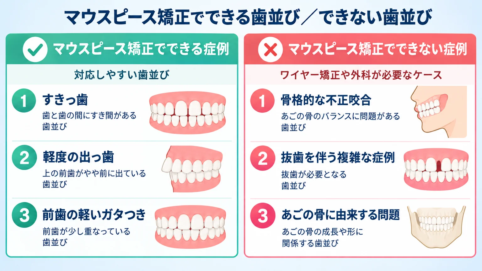 マウスピース矯正の適応症例と適応外症例を2列で比較するインフォグラフィック。対応しやすい歯並び（すきっ歯・軽度の出っ歯・前歯の軽いガタつき＝動かす量が少ない症例）と、ワイヤー矯正や外科が必要なケース（骨格的な不正咬合・抜歯を伴う複雑な症例・あごの骨に由来する問題）を左右に並べる。タイトルは『マウスピース矯正でできる歯並び／できない歯並び』