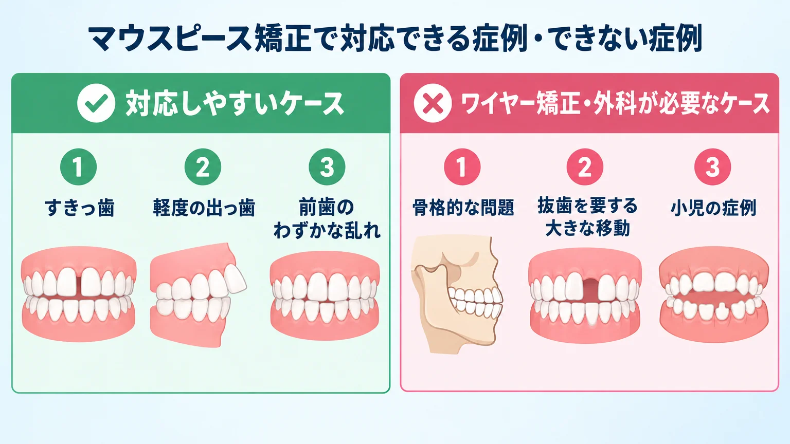 マウスピース矯正の適応ケースと非適応ケースを対比した図解。左側に「対応しやすいケース」（すきっ歯、軽度の出っ歯、前歯のわずかな乱れ）、右側に「ワイヤー矯正・外科が必要なケース」（骨格的な問題、抜歯を要する大きな移動、小児の症例）を歯のイラスト付きで並べる。タイトル「マウスピース矯正で対応できる症例・できない症例」