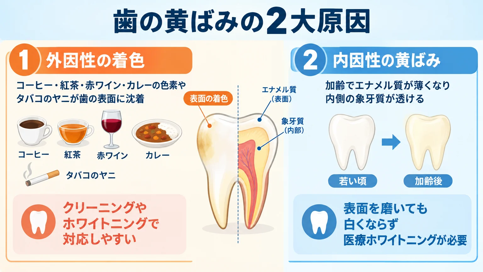 歯の黄ばみの2大原因を比較するイラスト。外因性の着色=コーヒー・紅茶・赤ワイン・カレーの色素やタバコのヤニが歯の表面に沈着、クリーニングやホワイトニングで対応しやすい。内因性の黄ばみ=加齢でエナメル質が薄くなり内側の象牙質が透ける、表面を磨いても白くならず医療ホワイトニングが必要。歯の断面図で表面と内部を描き分ける