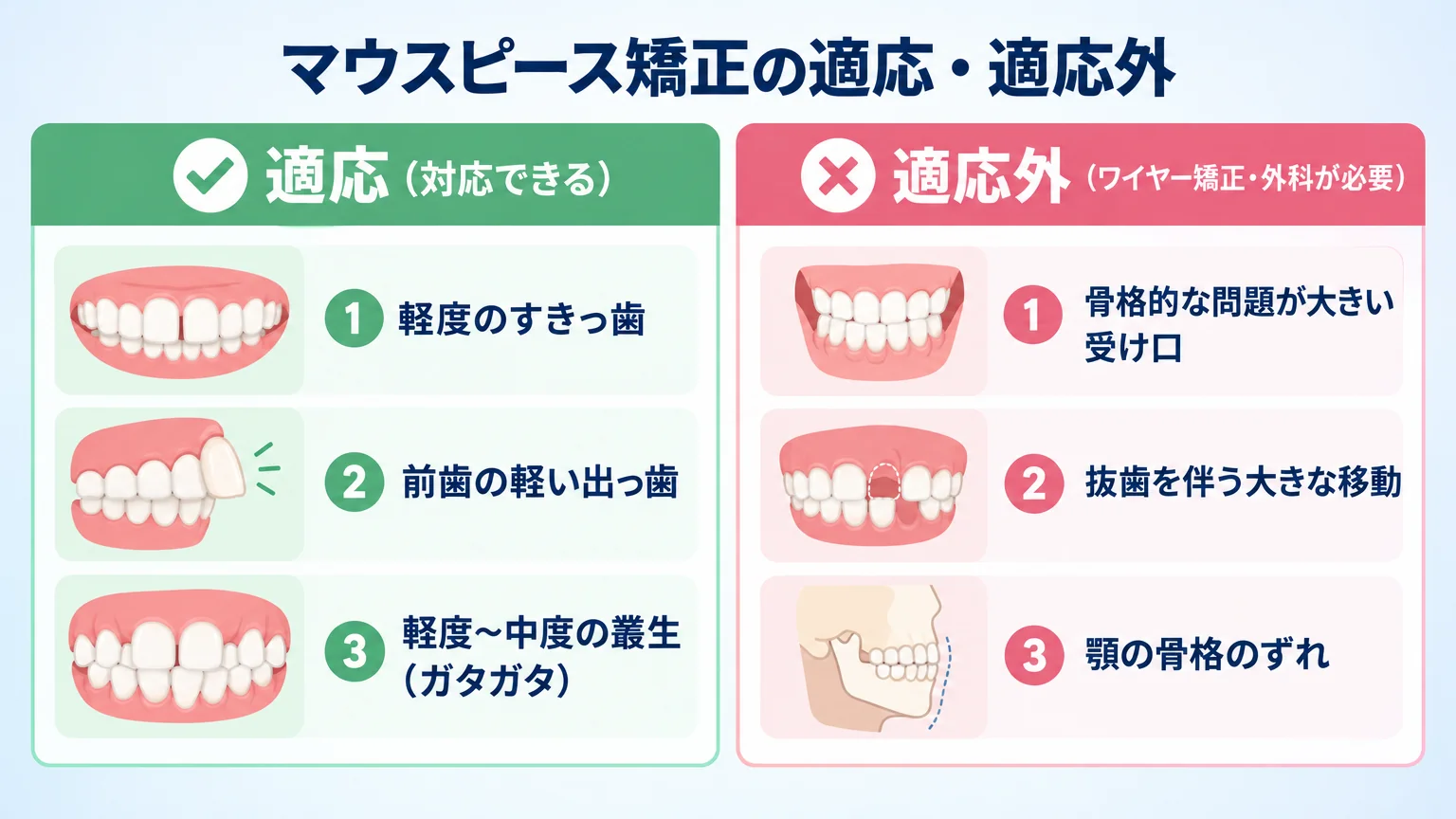 マウスピース矯正の適応・適応外を整理したインフォグラフィック。適応(対応できる)側に「軽度のすきっ歯」「前歯の軽い出っ歯」「軽度〜中度の叢生(ガタガタ)」、適応外(ワイヤー矯正・外科が必要)側に「骨格的な問題が大きい受け口」「抜歯を伴う大きな移動」「顎の骨格のずれ」を2列で対比