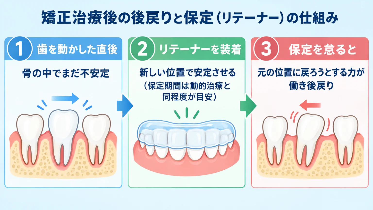 矯正治療後の後戻りと保定(リテーナー)の仕組みを示すイラスト。『①歯を動かした直後=骨の中でまだ不安定』→『②リテーナーを装着=新しい位置で安定させる(保定期間は動的治療と同程度が目安)』→『③保定を怠ると=元の位置に戻ろうとする力が働き後戻り』の3ステップをフロー図で示す